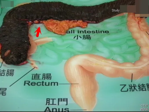 獨家|OL真的一肚子大便!1個月才嗯嗯1次 這手術讓她終於順暢愉快