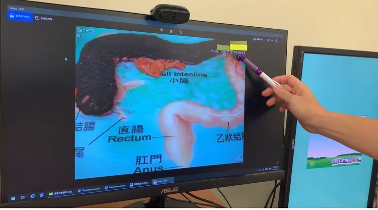 蔡鎧隆醫師手指著這名OL切下的大腸，指因長期受軟便藥刺激、色素沈澱，腸道異於常人，是黑的，且黑到發亮。吳慧芬攝