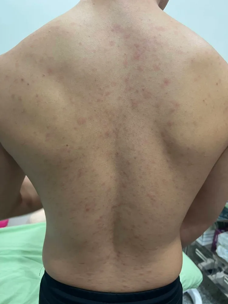 男子與網友發生一夜情後，隔周身體即出現紅疹。蘇信豪醫師提供