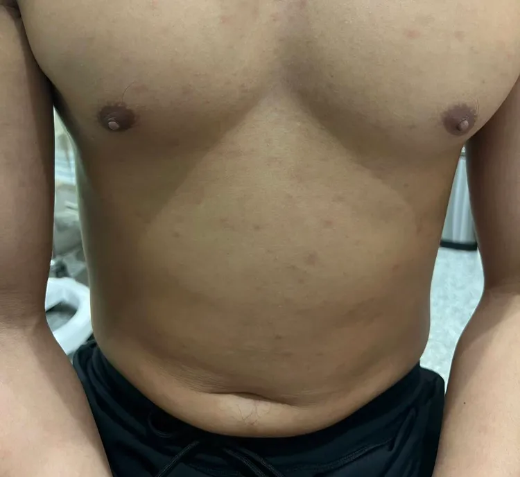 男子與網友發生一情後，隔周身體出現紅疹。蘇信豪醫師提供