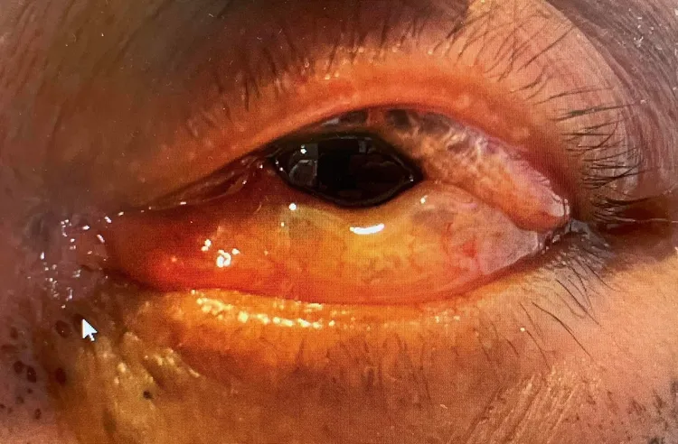 阿伯的結膜下方有空氣，出現眼白冒出泡泡的「泡泡眼」。讀者提供