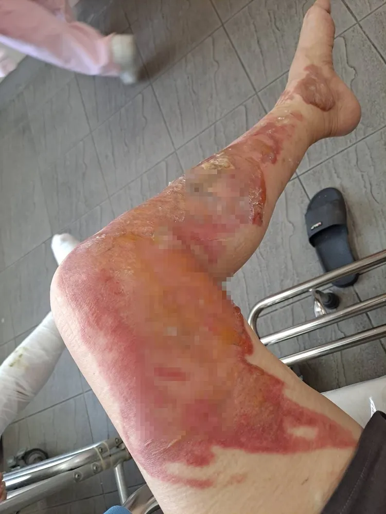 高雄蔣姓女子在坐月子中心工作，左腿遭到燙傷。翻攝臉書爆料公社公開版