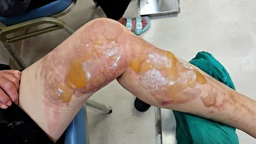 怵目惊心!高雄女厨房工作遭烫伤 家属怒控业者未协助送医