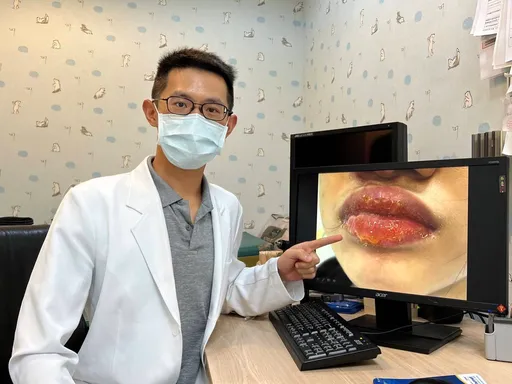 她香腸嘴+流膿!原來是「這病」作怪 嚴重恐爆敗血症