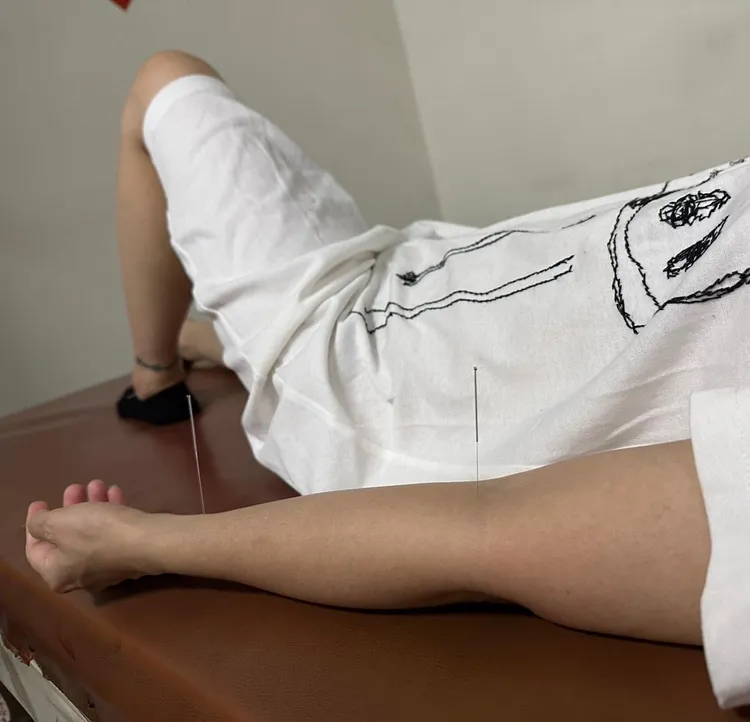 詹雅雯目前靠針灸治療。取自詹雅雯臉書