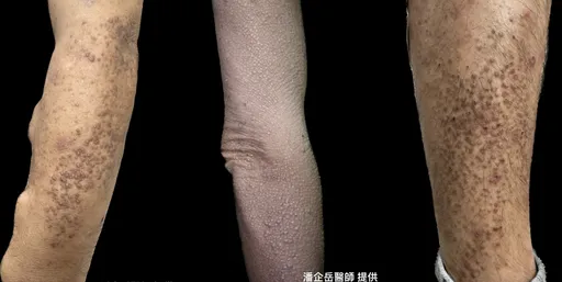 他猛抓癢抓出蟾蜍皮 密布棕色角質顆粒!醫警告3行為當心