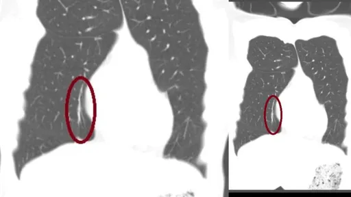 妹子一直咳！醫師看電腦斷層大驚：慘了！肺爆炸了