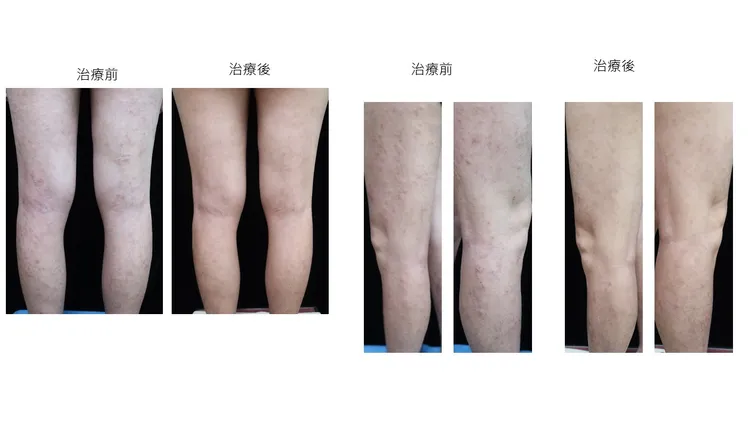 異位性皮膚炎患者治療前後對比照片。黃毓惠醫師提供