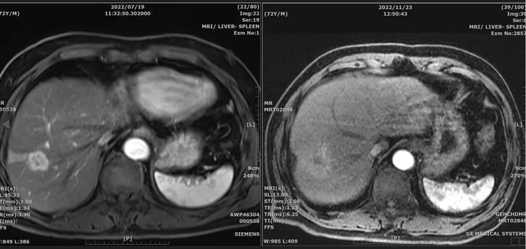 4次治療後，童先生的肝臟腫瘤完全消失。北榮提供