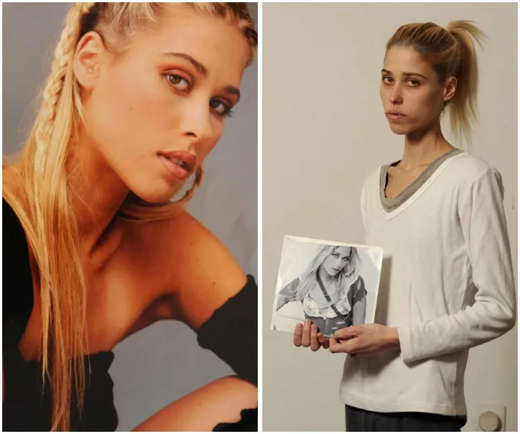 以色列名模卡琳鮑曼因罹患神經性厭食症13年，瘦成紙片人，上週二因感染肺炎惡化病逝。翻攝《Ynet》