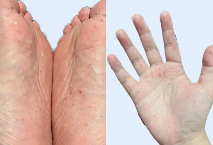 手指、腳趾頭竟冒出一顆一顆的小水泡是腸病毒的典型症狀。基隆部立醫院提供