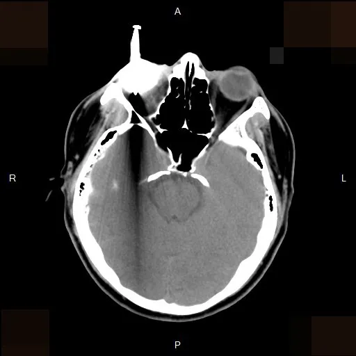 電腦斷層影像可看到男子右眼插著一根釘子，直達眼球的後方。李學宇醫師提供
