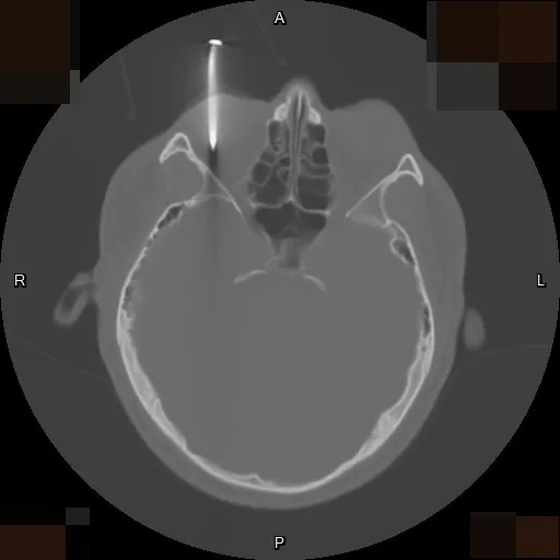 電腦斷層影像可看到男子右眼插著一根釘子，直達眼球的後方。李學宇醫師提供
