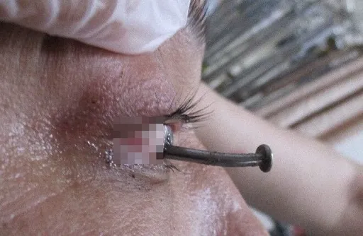 獨家|驚悚慎入!他插著這根「眼中釘」走進急診室嚇壞女醫