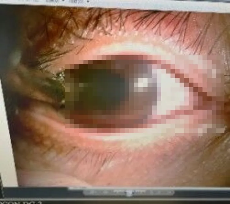 男子使用釘槍工作時，一個不小心釘子刺進右眼裡。林佳蓉醫師提供