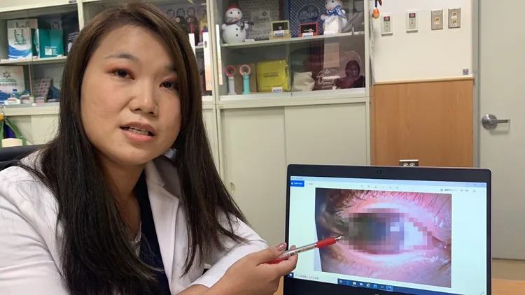 林佳蓉醫師表示，病患若有異物刺進眼睛，應閉目儘速就醫。吳慧芬攝