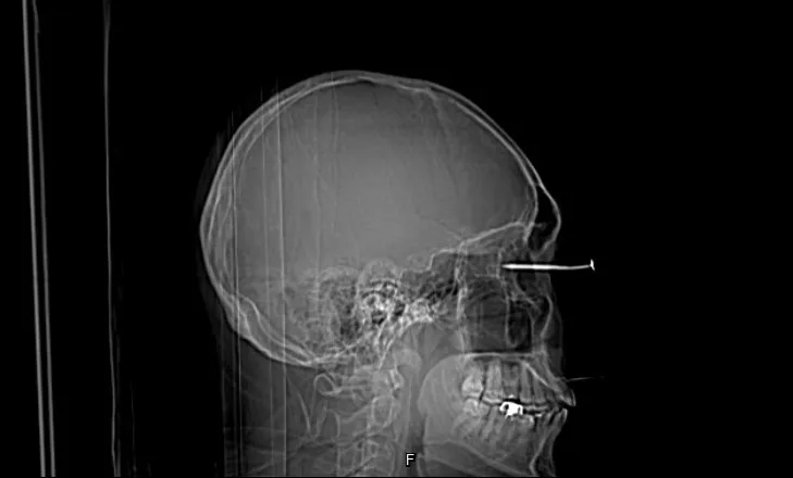 電腦斷層影像可看到男子右眼插著一根釘子，直達眼球的後方。李學宇醫師提供
