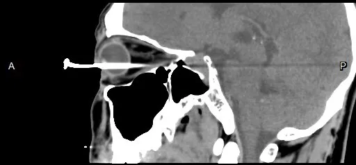 電腦斷層影像可看到男子右眼插著一根釘子，直達眼球的後方。李學宇醫師提供