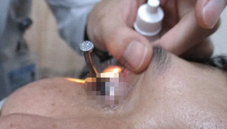 男子走進高醫急診室時，右眼就插著一根釘子。林佳蓉醫師提供