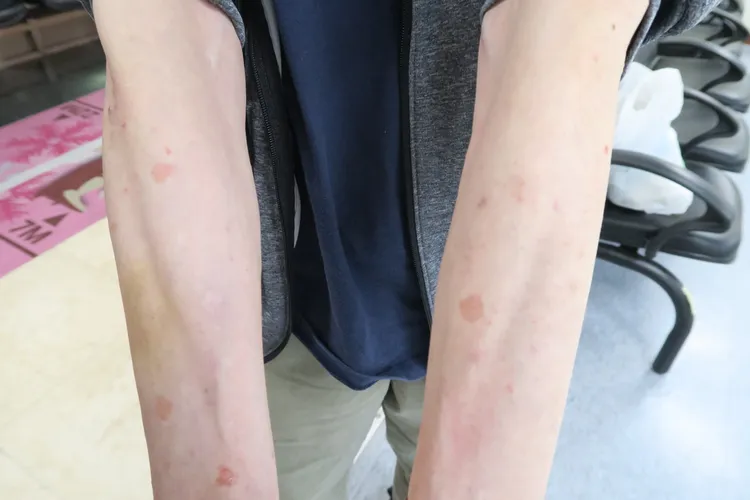 張姓高中老師因皮膚有陽光過敏症，卻因施打類固醇不當，出現多重病症。彰化醫院提供