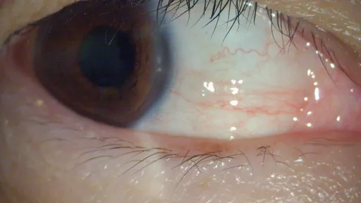 淚水直流竟是乾眼症!她頻眨眼一查已角膜破皮 出現這些症狀快就醫