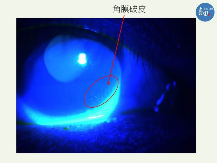 乾眼症長期未治療，嚴重時會造成角膜受損、潰瘍。書田診所提供