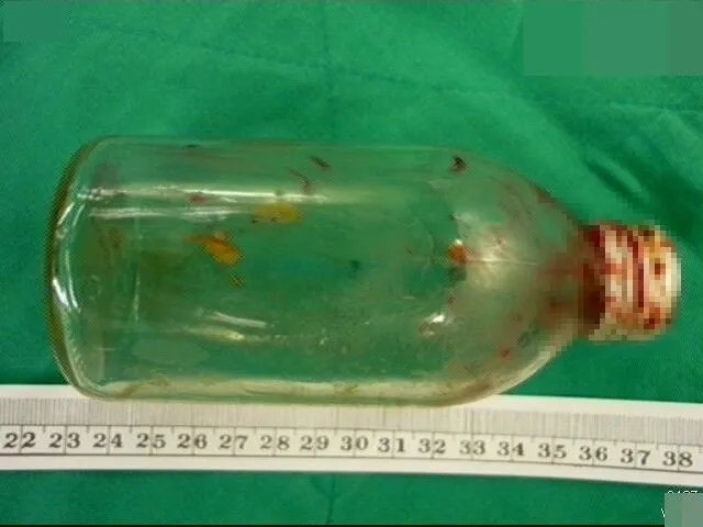 蔡鎧龍醫師曾從肛門異物求診者患者體內取出長15公分的玻璃瓶，因已刺傷腸道，瓶身血跡斑斑。蔡鎧隆醫師提供