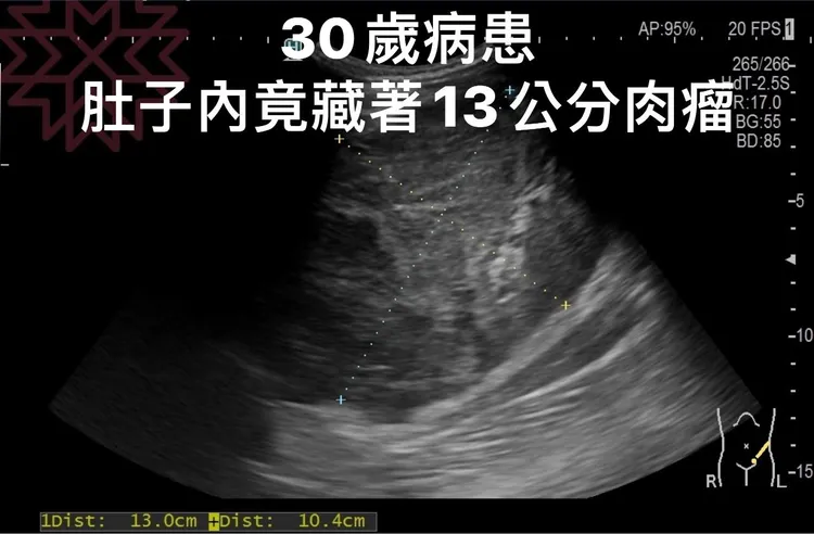 30歲病患肚內有13公分腫瘤。翻攝自胰臟醫師 林相宏 禾馨民權內科診所臉書