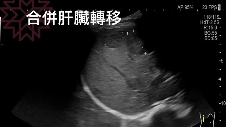 惡性肉瘤合併肝臟轉移。翻攝自胰臟醫師 林相宏 禾馨民權內科診所臉書