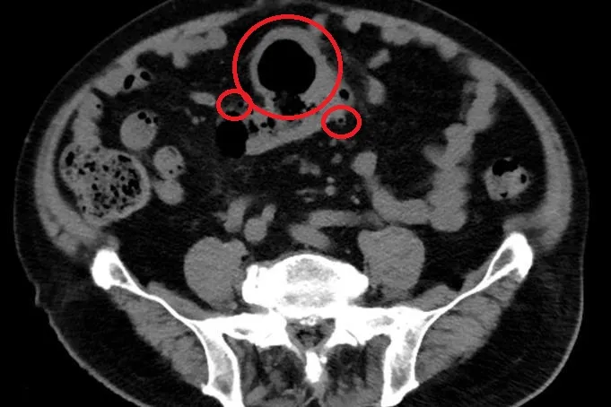 電腦斷層顯示大腸已有多處憩室。台北慈濟提供