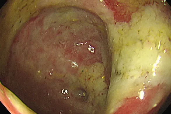 大腸鏡發現憩室已發炎潰爛。台北慈濟提供