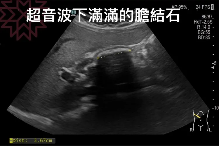 患者膽囊裡面有夠恐怖，滿滿的結石。翻攝自林相宏臉書