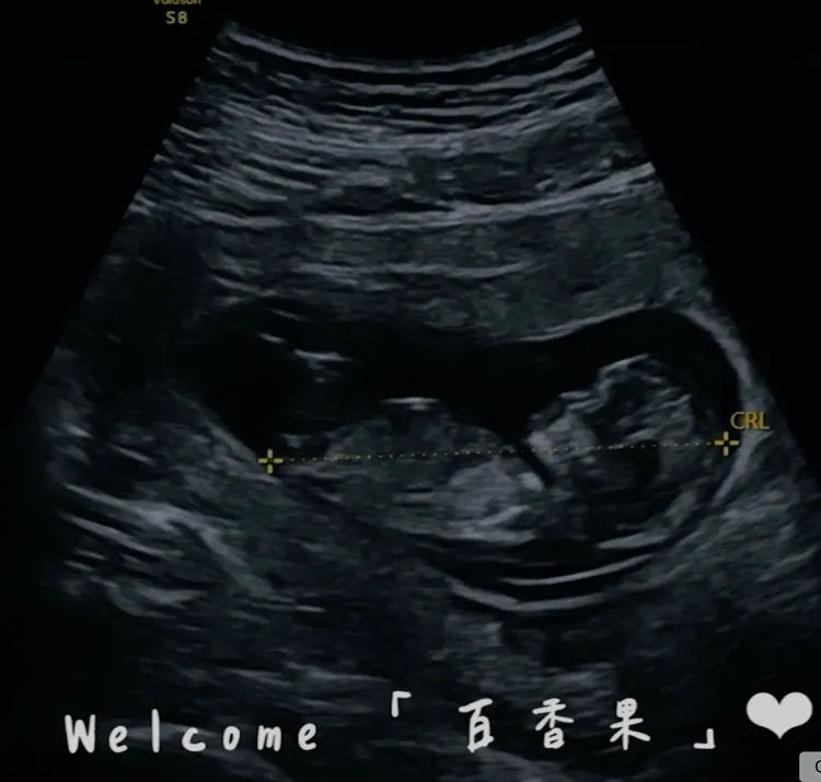 威廉分享小孩的超音波照。翻攝威廉臉書
