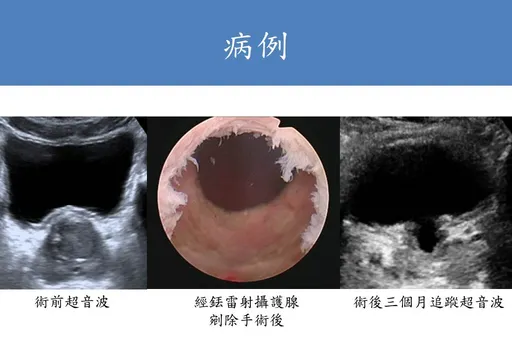 攝護腺肥大尿不完!4狀況建議手術 高齡靠「這招」清空下水道
