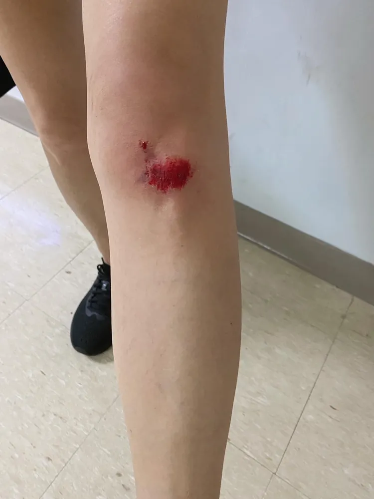 辛曉琪分享自己的傷勢。翻攝辛曉琪臉書