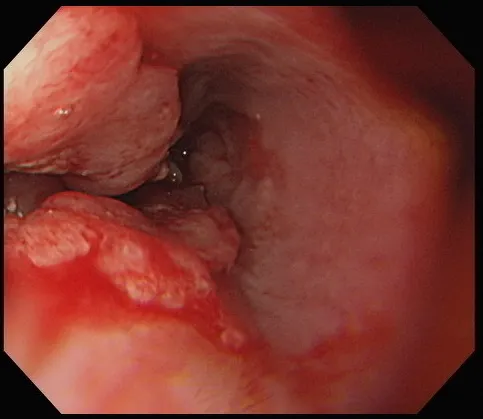 47歲司機等到自己「吞口水也會痛」才就醫，發現食道中段已冒出長達7公分腫瘤。亞大附醫提供