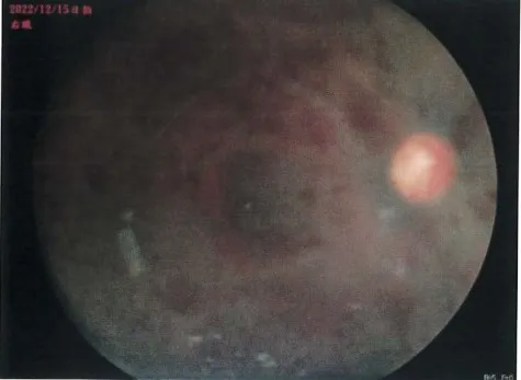 眼底攝影顯示男嬰右眼眼底出血。翻攝畫面