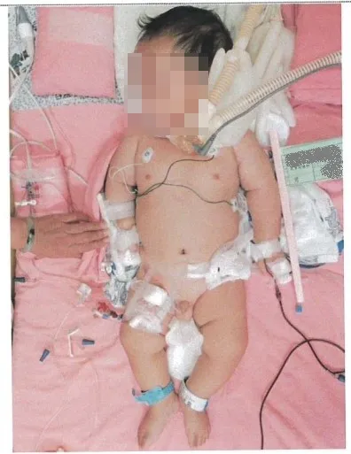 男嬰遭保母虐待，造成視力及腦部永久性損傷之重大難治傷害。翻攝畫面