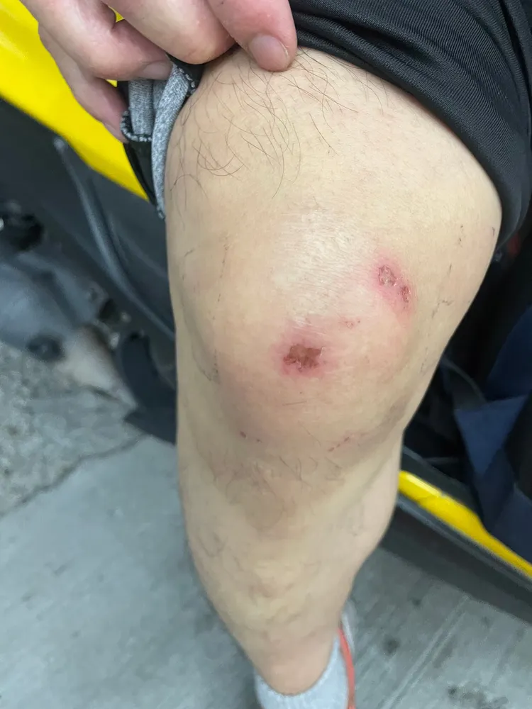 陳男膝蓋也在警方壓制過程中受傷。陳男提供