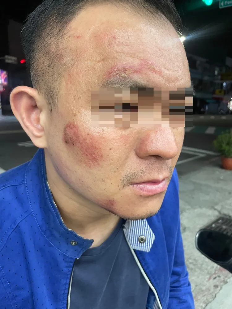 陳男臉部呈現紅腫擦挫傷。陳男提供