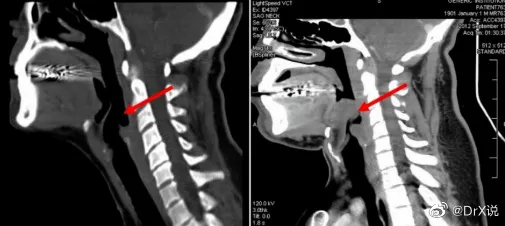 26歲女半夜吃辛辣火鍋喉嚨痛　10小時後竟無法呼吸憋死