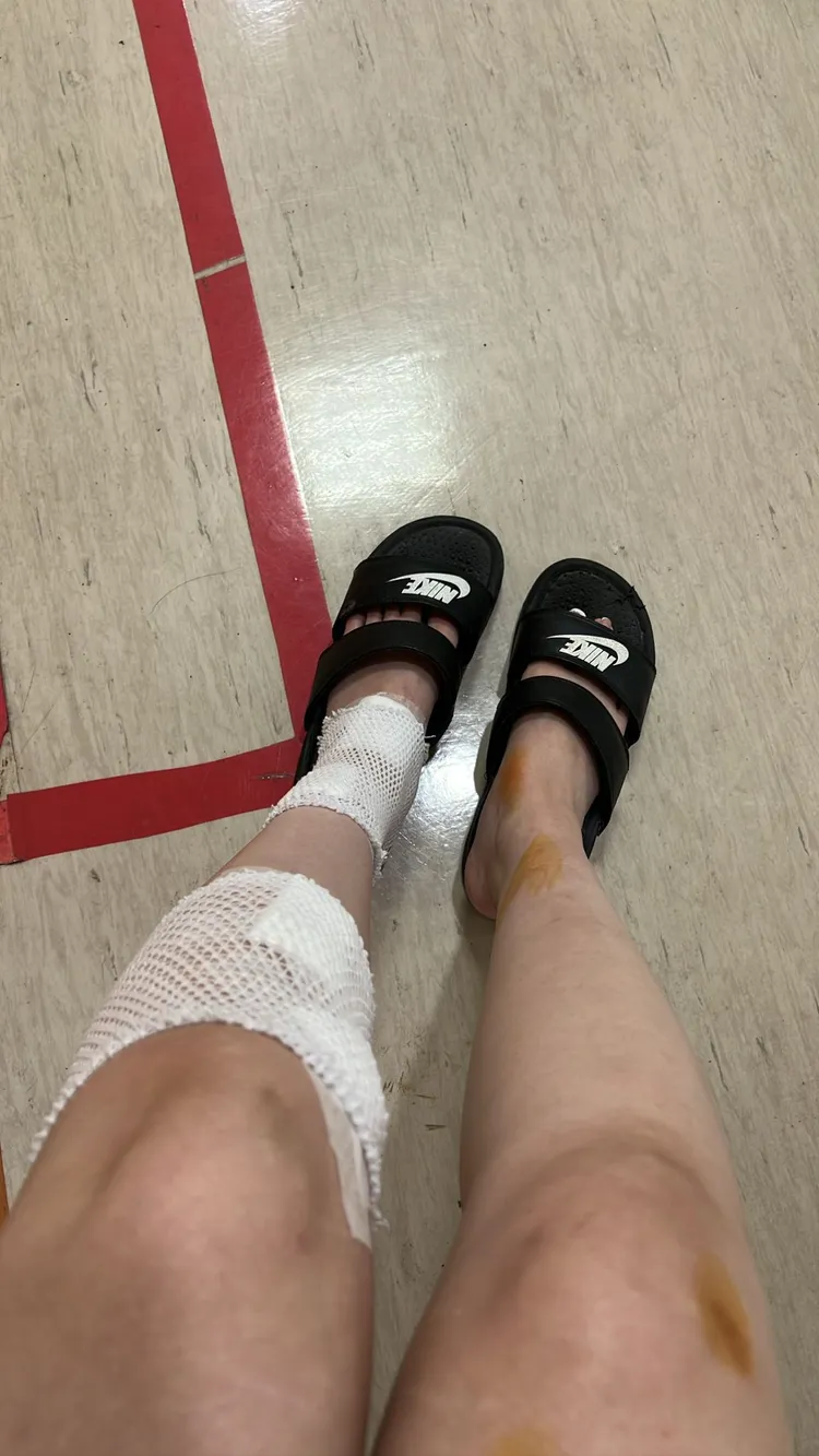 舒子晨左小腿傷較多。經紀人八角提供