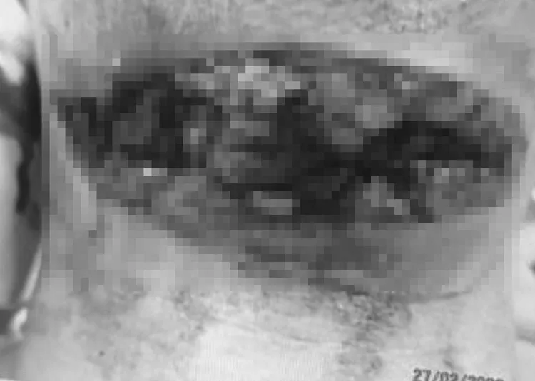 游男說，只差幾毫米就傷到氣管。游男提供