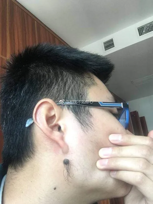 你的擾人痣毛其實是禿頭救星 內含刺激毛囊重生蛋白質