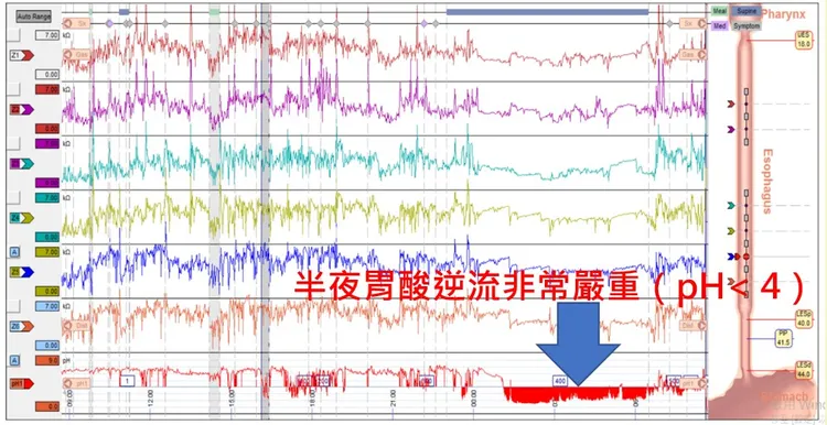 謝先生在接受24小時酸鹼測試結果，發現在夜間尤其是躺下時胃酸逆流非常嚴重（pH4）。中國附醫提供