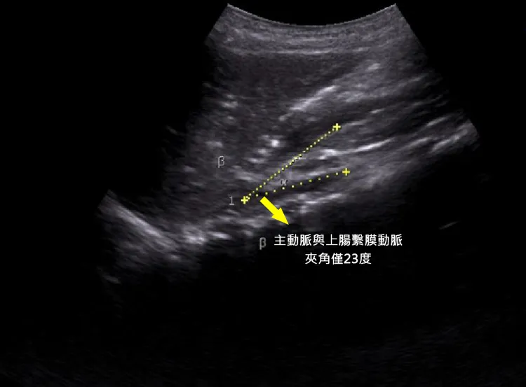 男童主動脈與上腸繫膜動脈夾角僅23度。院方提供