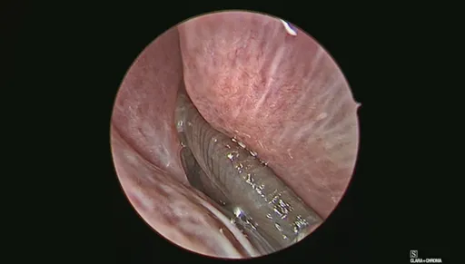 異形片慎入!老翁流鼻血就醫竟拉出這東西「狂蠕動」 醫師:恐跟洗臉有關