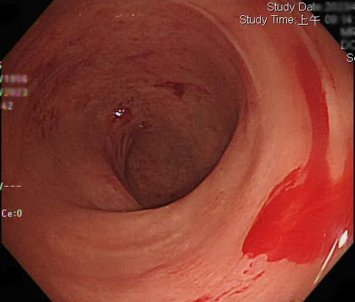 這次別怪火龍果！便便顏色像葡萄酒　血管異常增生惹禍