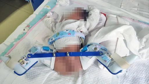 嬰兒出生狂哭又腿腫　竟是醫師隱瞞「剖腹接生掰斷骨」