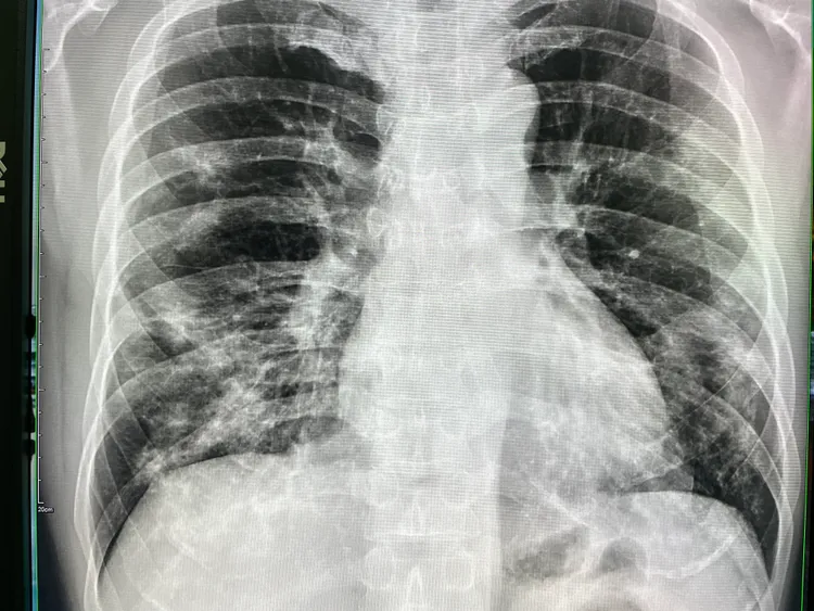 施先生肺部X光出現嚴重實質性浸潤。烏日林新醫院提供